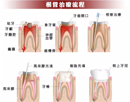 根管治疗图示