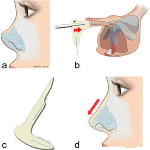 鼻整形过程图示