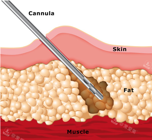 吸脂手术示意图