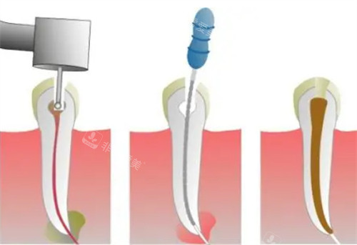 根管治疗过程图解