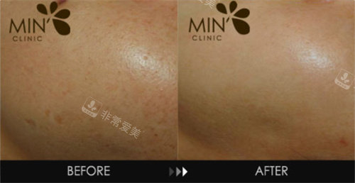 韓國MinClinic皮膚注射前后對比圖