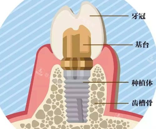 種植牙組成示意圖