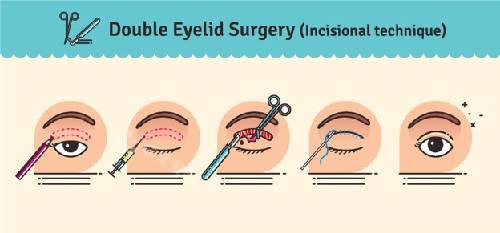 双眼皮手术过程