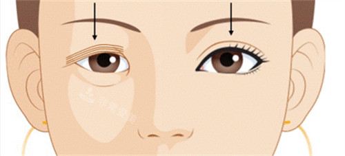 唐山艾玲医疗美容双眼皮手术前后对比图