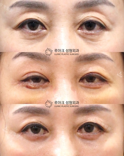 韓國luarc整形做眼部提肌手術(shù)圖片