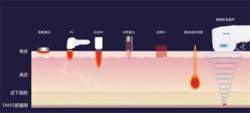 为什么不建议做超声炮？做超声炮加速衰老是真的吗