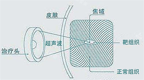 超聲炮原理