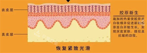 熱瑪吉作用原理 熱瑪吉作用原理