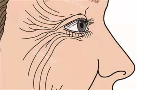 眼周皺紋 眼周皺紋