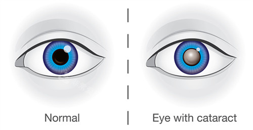 正常眼睛和白内障眼睛