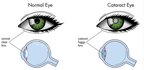 白内障眼底情况