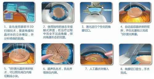 超声乳化术手术过程