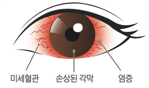 眼部炎症的样子图解