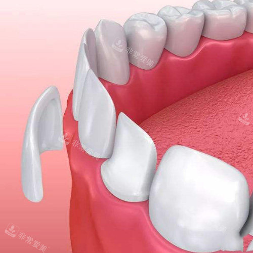 牙齿贴面图示