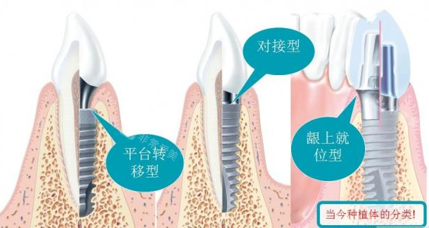 不同植体类型图示