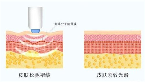 为什么热玛吉不会导致脸垮