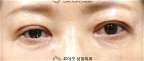 韩国luarc整形埋线双眼皮恢复期