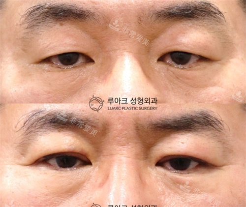 韩国luarc整形埋线双眼皮术前术后对比照