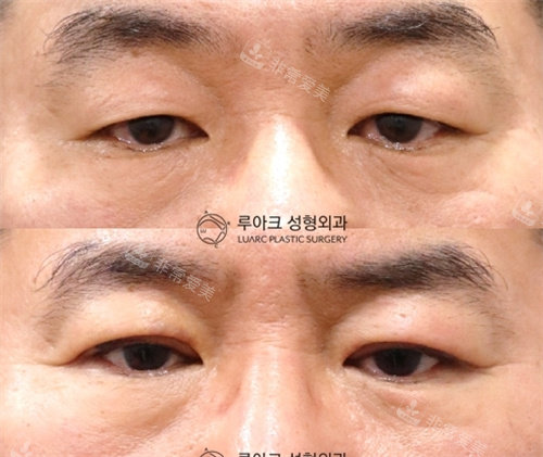 韓國luarc整形埋線雙眼皮術(shù)前術(shù)后對比照