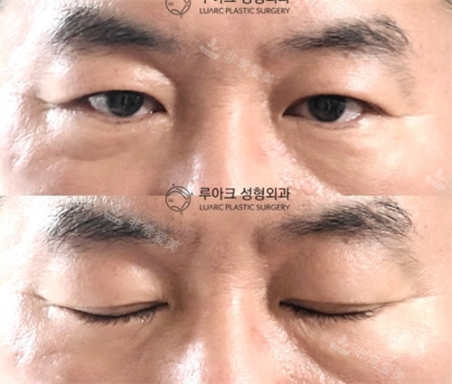 韓國luarc整形埋線雙眼皮術(shù)前術(shù)后對比照