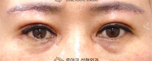 韓國luarc整形埋線雙眼皮恢復(fù)期