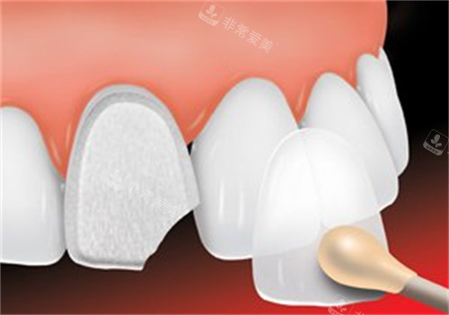 牙齿贴面改善牙齿颜色和缺损