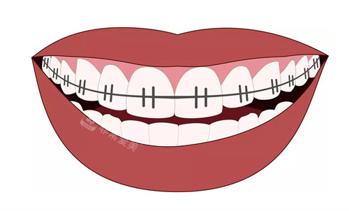 牙齿矫正改善牙齿畸形