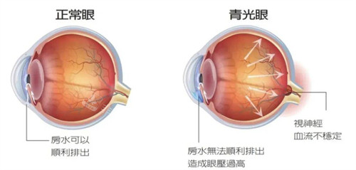 正常眼睛和青光眼结构不同