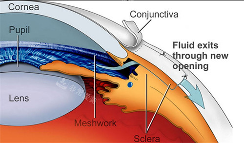 青光眼眼睛结构