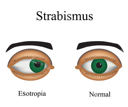 斜视和正常眼睛的区别图解
