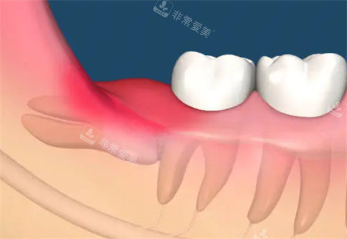 智齒發(fā)炎照片 智齒發(fā)炎照片