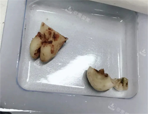 拔牙后的牙齒照片 拔牙后的牙齒照片