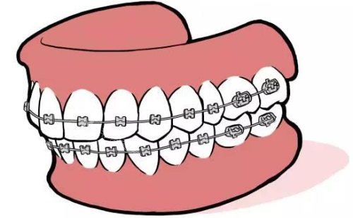 牙齿矫正示意图