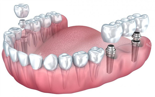 单颗种植牙和连冠的种植牙