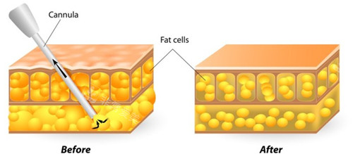 吸脂原理对比图