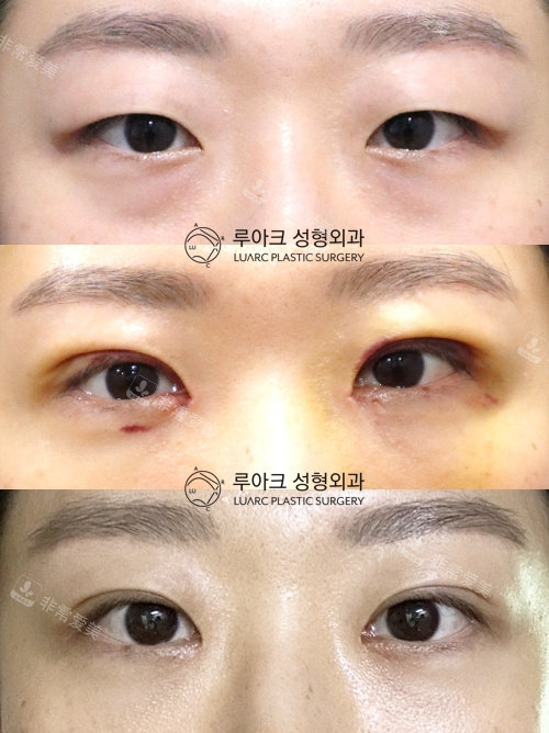 韩国luarc整形外科双眼皮手术