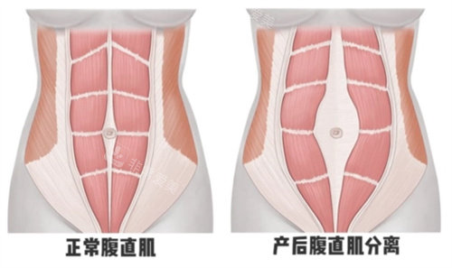 什么情況要做腹壁整形術(shù) 什么情況要做腹壁整形術(shù)