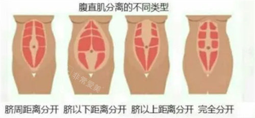 腹直肌分離 腹直肌分離