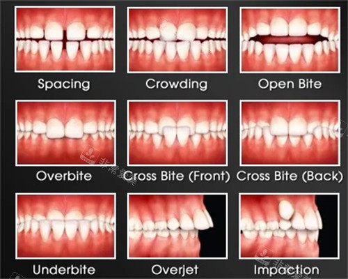 各类需要矫正的牙齿