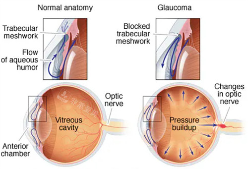 青光眼眼球出现问题的部分