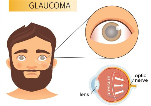 青光眼眼部问题和外观