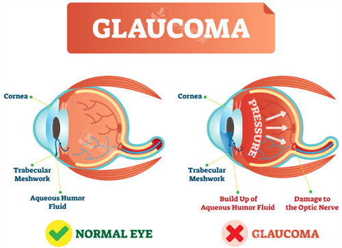 正常眼睛和青光眼眼睛的不同