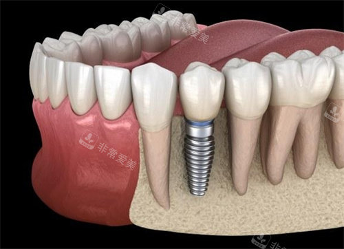 种植牙动画图