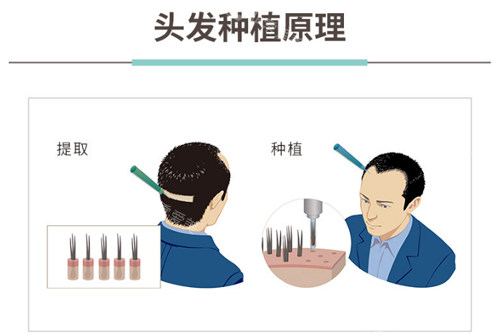 植發(fā)原理圖示 植發(fā)原理圖示