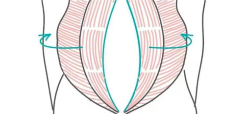 腹壁成型手术