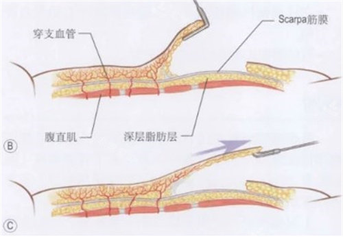 腹壁整形手术