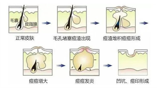 点阵激光设备哪个牌子好？点阵激光祛痘坑选哪个？