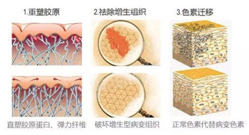 点阵激光对增生性疤痕有用吗？疤痕点阵激光几次可以变平