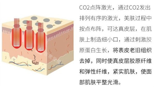 點陣激光原理