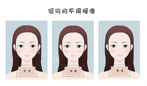 不同程度的泪沟